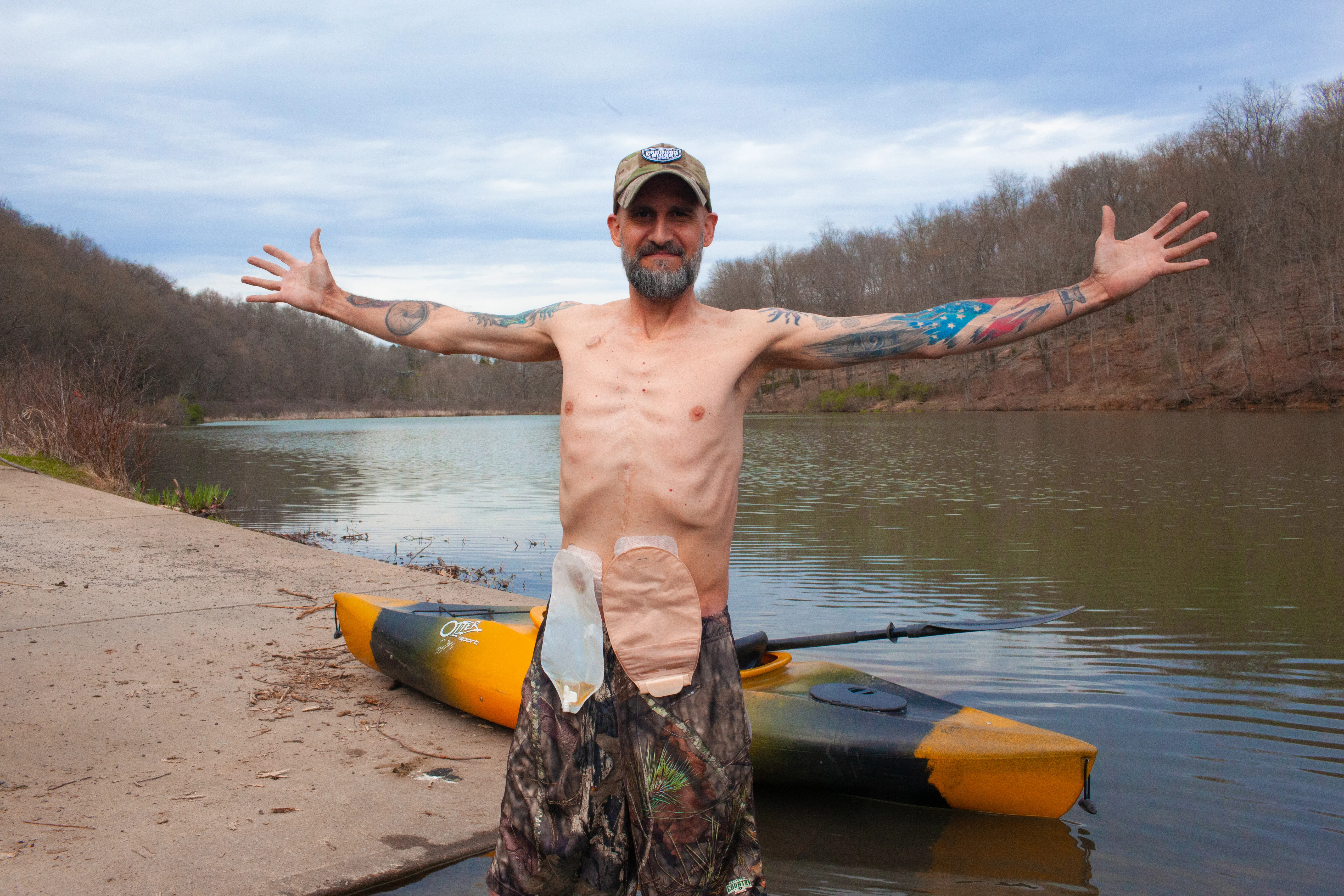 Person with double ostomy without leaks.